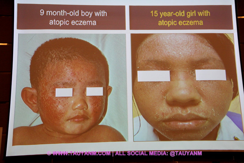 Avène Atopic Eczema